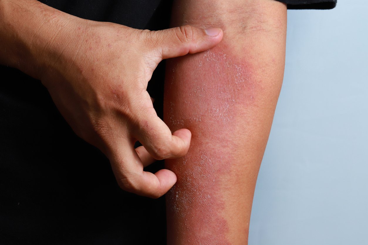 Swimmer's itch: Symptoms, causes, treatment, and more